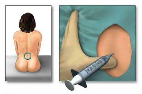 Il blocco peridurale (epidurale)
